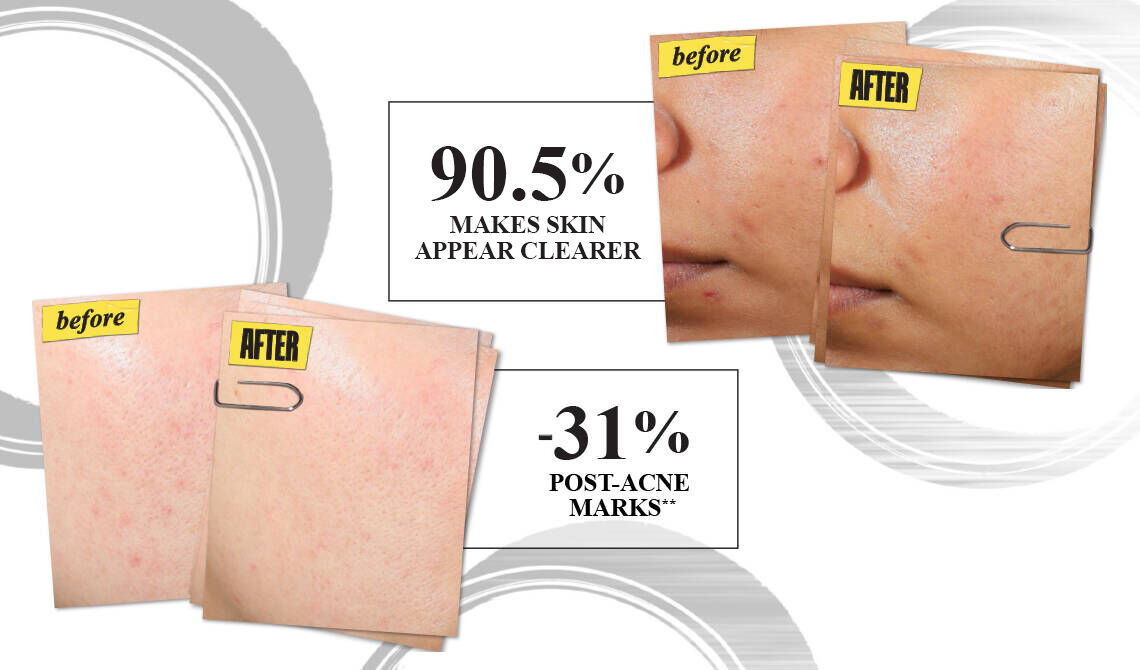 Expertly Clear Blemish Lotion | Treat & Prevent Acne | Kiehl's